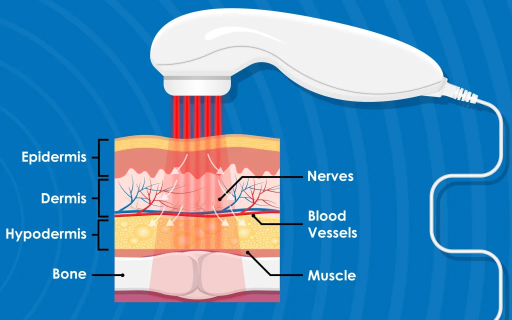 Illustration of  laser penetrating skin, nerves, blood vessels, muscles, and bone.